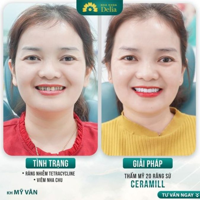 Răng sứ 3 triệu có những hãng sứ nào?