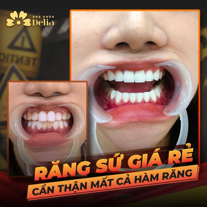 Răng sứ 700k có quy trình sản xuất đơn giản