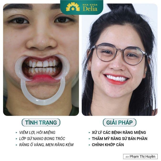 Răng sứ 700k tiềm ẩn rủi ro với sức khỏe răng miệng