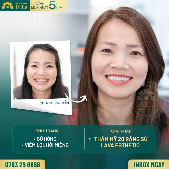 So sánh răng sứ 800K kim loại và răng toàn sứ