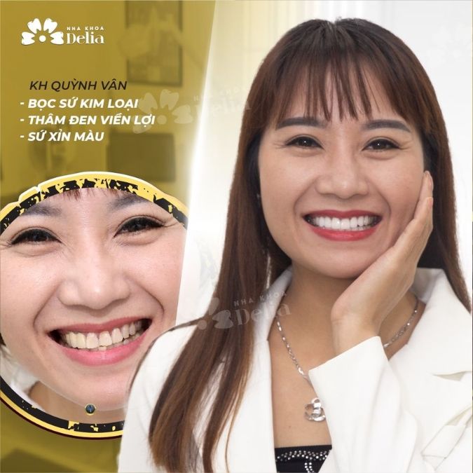 Răng sứ 800K là loại răng sứ gì? Sự thật về răng sứ giá rẻ