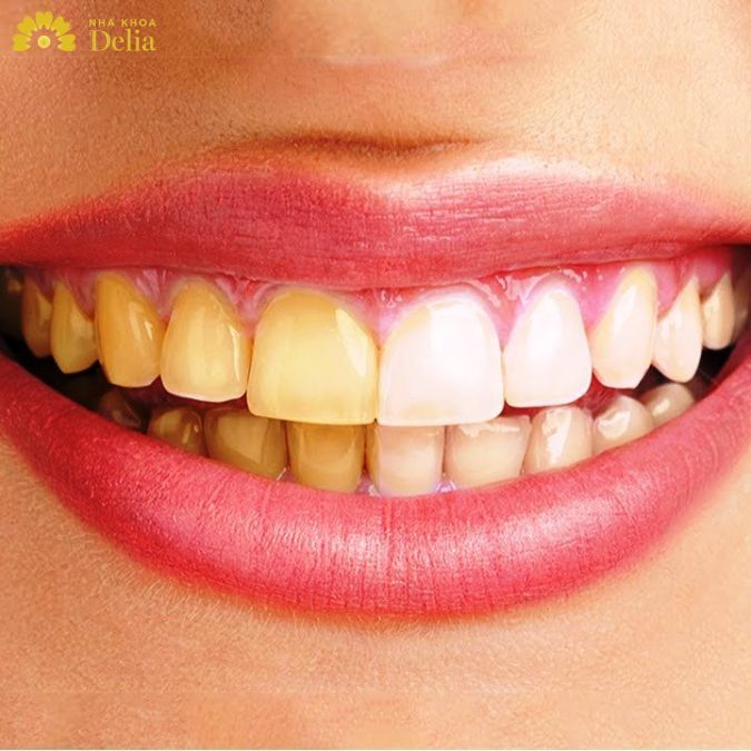 Răng sứ có bị xuống màu không còn tùy thuộc vào nhiều yếu tố