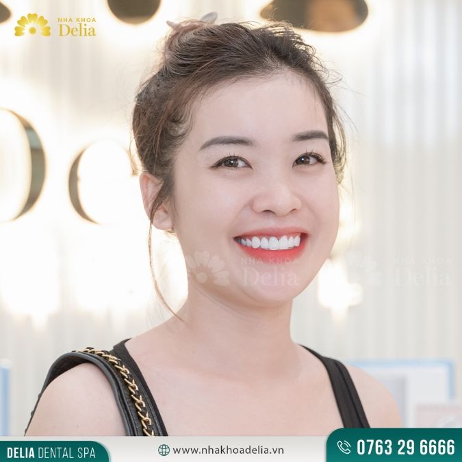 Ưu điểm nổi bật của răng sứ khểnh