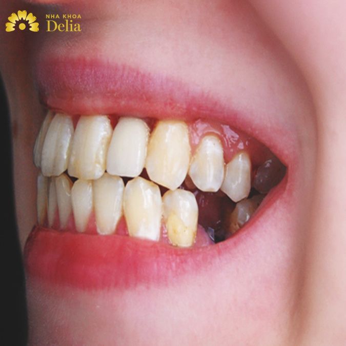 Di truyền từ người thân trong gia đình tăng khả năng chân răng bị sâu
