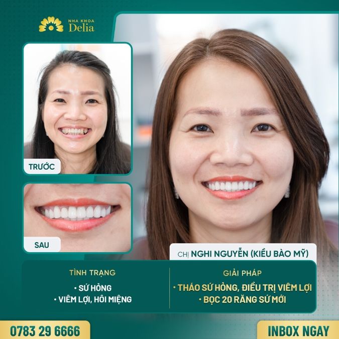 Bọc răng sứ rồi có tháo ra được không?