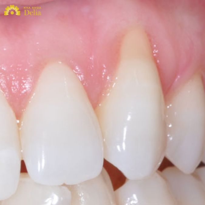 Tụt lợi có thể bọc răng sứ để cải thiện khuyến điểm