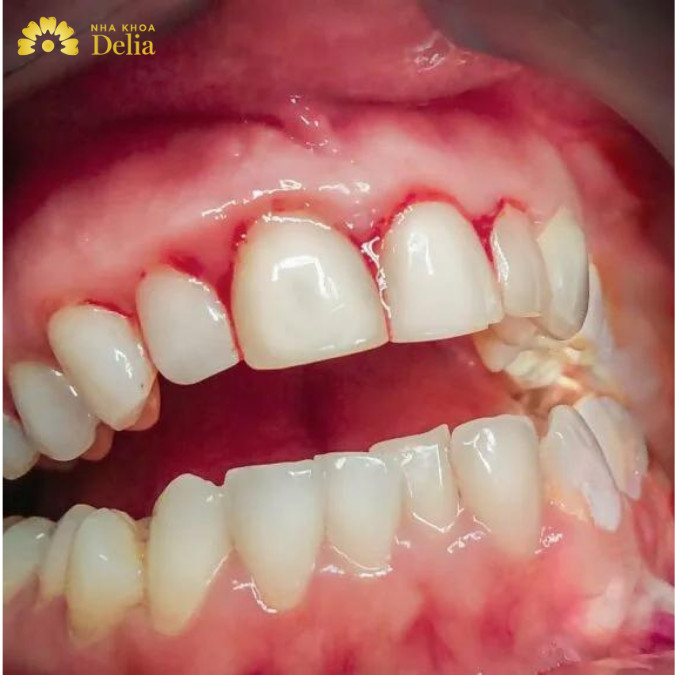 Hình ảnh viêm chân răng hàm dưới 