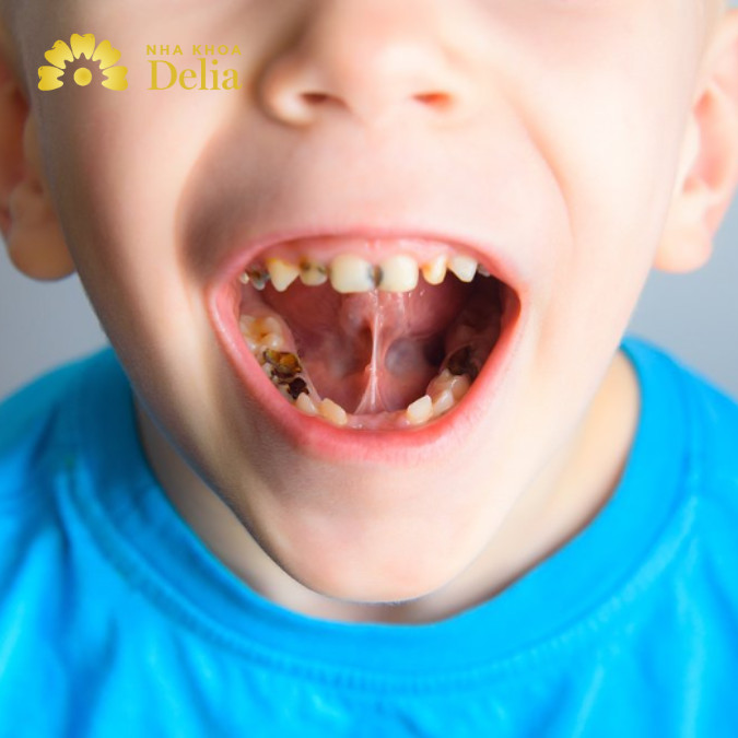 Viêm chân răng có mủ ở trẻ em 