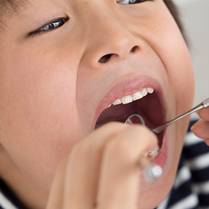 Điều trị viêm chân răng có mủ cho trẻ tại nha khoa