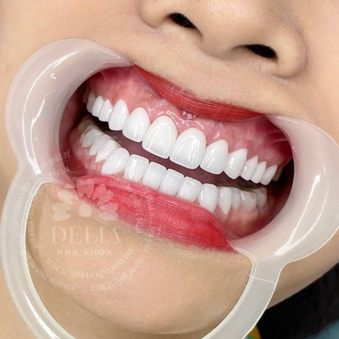 Với lớp phủ kim cương non siêu mỏng bên ngoài, răng sứ Diamond mang lại vẻ đẹp tự nhiên và sáng bóng