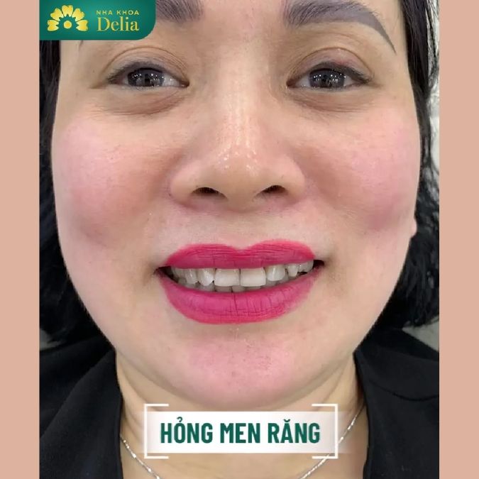 Khách hàng Việt Hà trải nghiệm làm 24 răng sứ Lava Plus tại nha khoa Delia