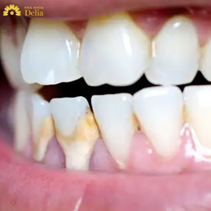 Chân răng màu trắng là tình trạng không quá nguy hiểm