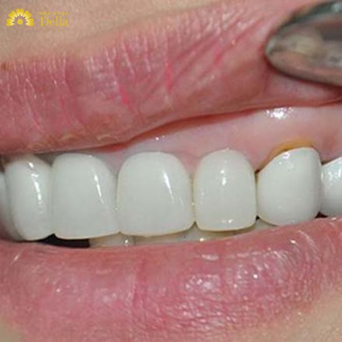 Việc sử dụng thuốc đặc trị cũng có thể khiến chân răng đổi màu xanh