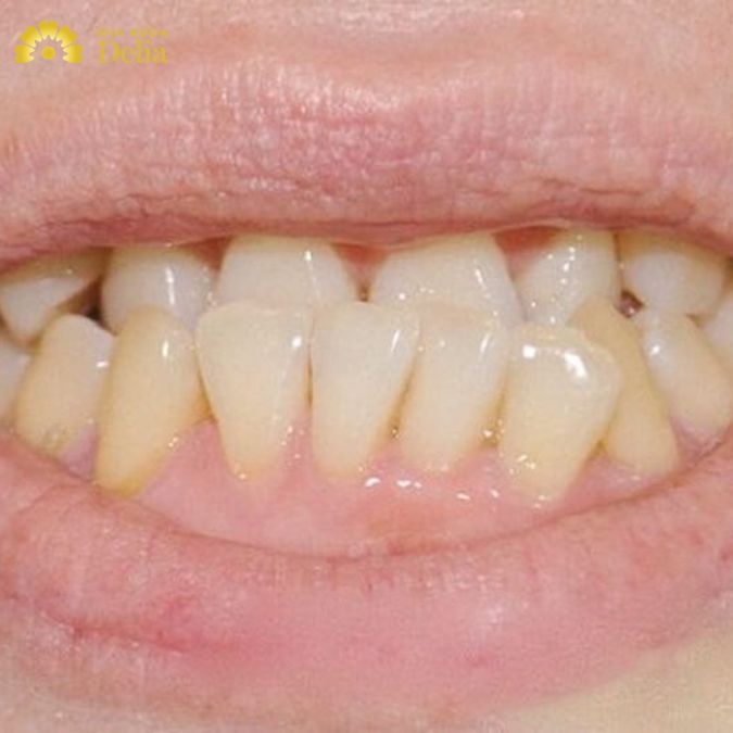 Tính thẩm mỹ của răng bị ảnh hưởng nặng nề khi chân răng mọc lệch