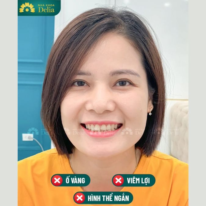 Khách hàng Bích Liên trải nghiệm làm răng sứ Lava Plus tại nha khoa Delia