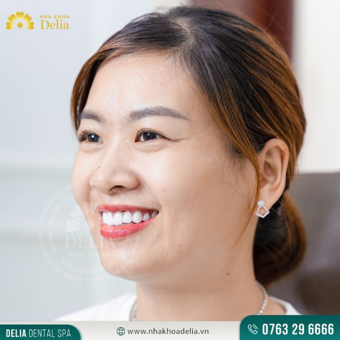 Không ảnh hưởng đến chức năng ăn nhai sau khi dán sứ