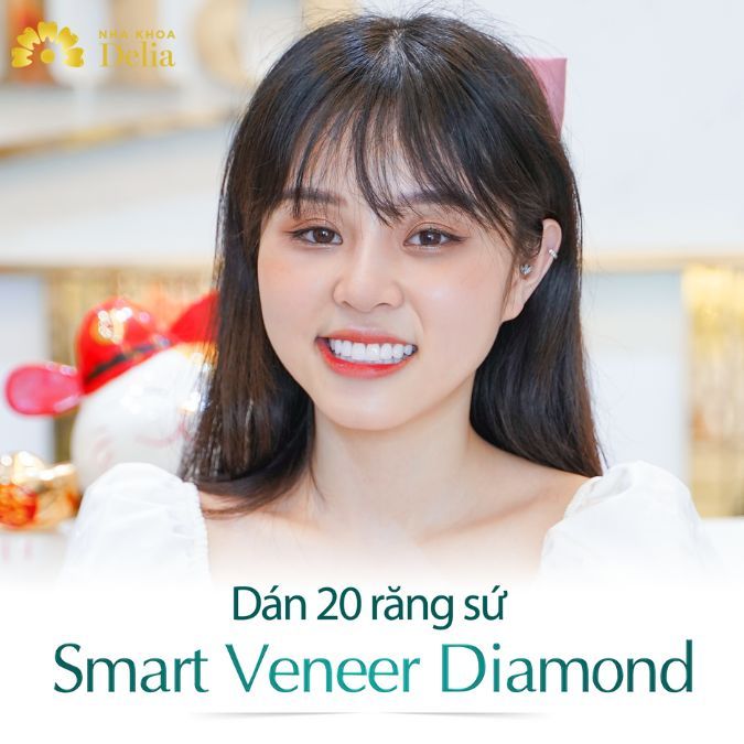 Smart Veneer Diamond