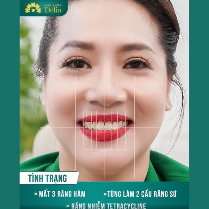 Diễn viên Thu Huyền trải nghiệm làm răng sứ và trồng Implant tại nha khoa Delia