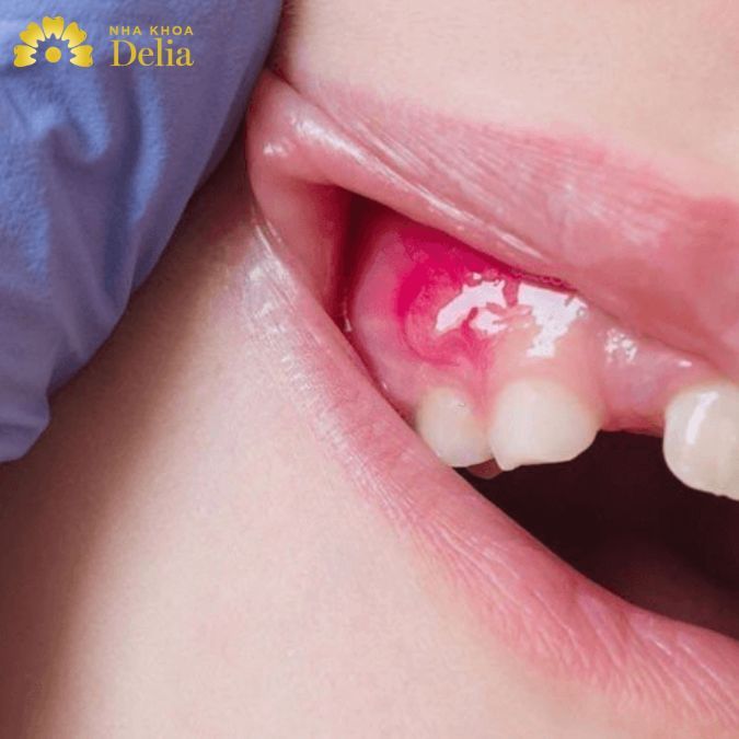 Trong giai đoạn đầu, áp xe răng sẽ khiến nướu bị sưng đỏ