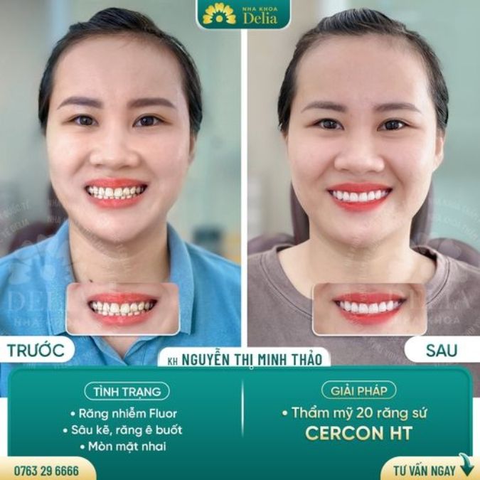 Hình ảnh bọc răng sứ Cercon HT của khách hàng 