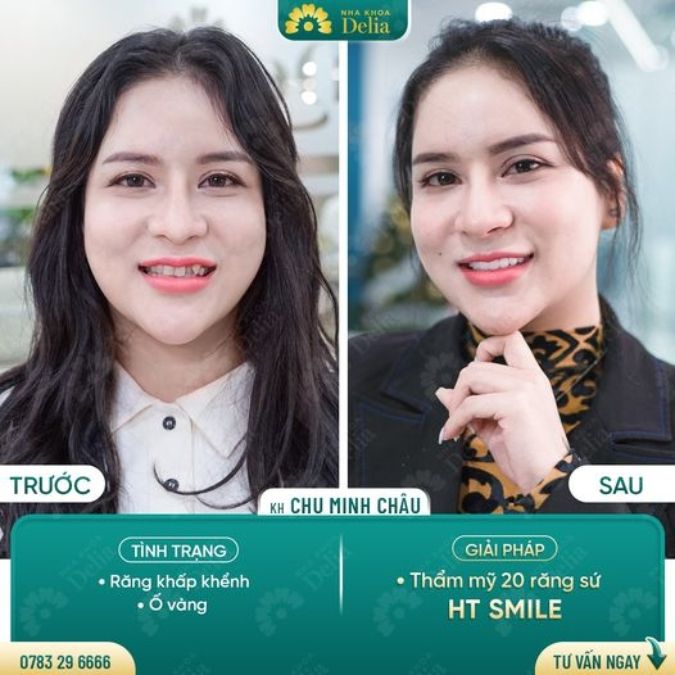 Hình ảnh bọc răng sứ HT Smile của khách hàng 