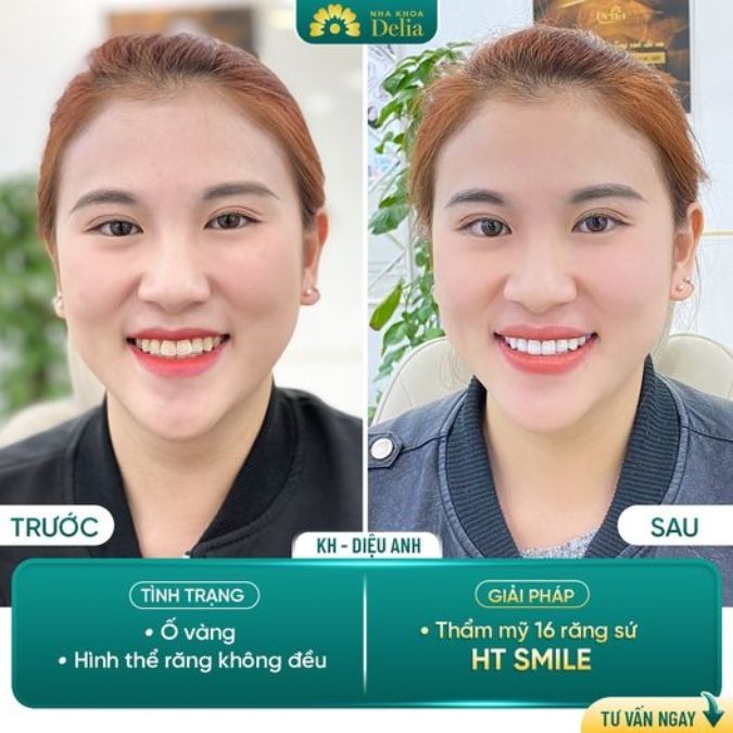 Hình ảnh bọc răng sứ HT Smile của khách hàng 