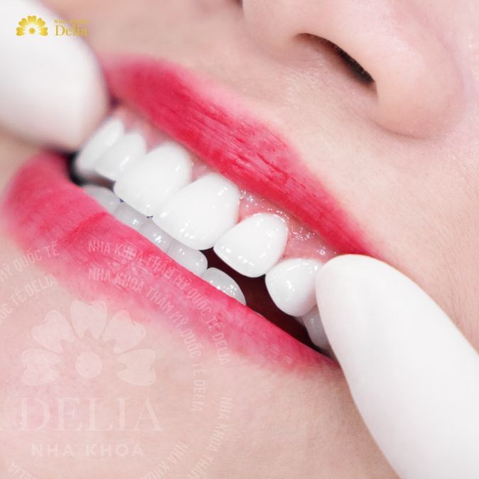 Hình ảnh bọc răng sứ Emax của khách hàng 