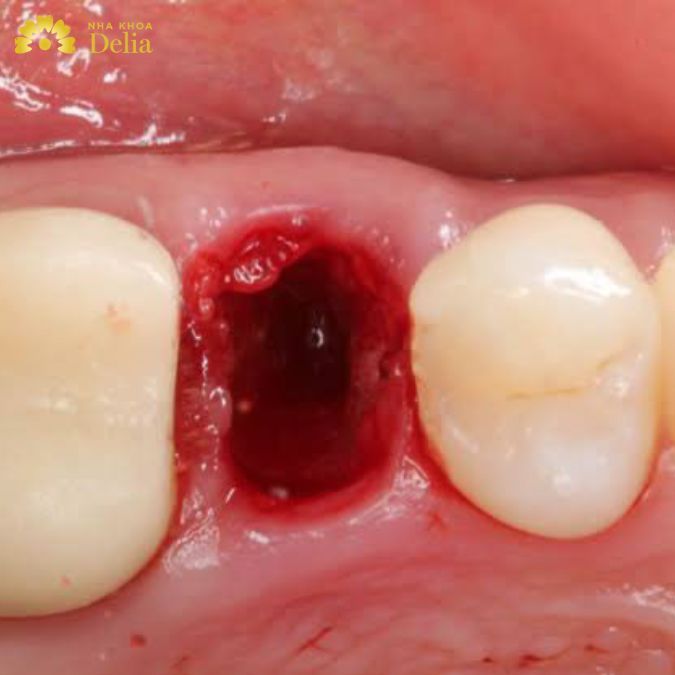 Lợi có thể xuất hiện mủ và không cầm được máu là biến chứng sau khi nhổ răng bạn nên cẩn thận