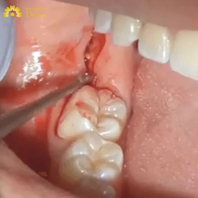 Lợi bị sưng sau khi nhổ răng