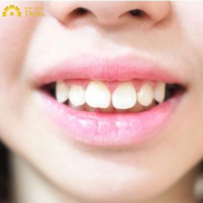 Hình ảnh hàm răng hô với khoảng cách giữa răng cửa hàng trên và hàm dưới khoảng 2.5 -  4mm