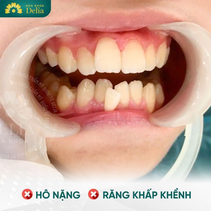 Dùng tay tác động lực lên răng hô