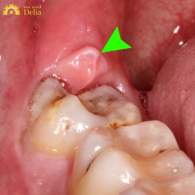 Hình ảnh sâu răng viêm lợi nếu như không chữa trị sớm 