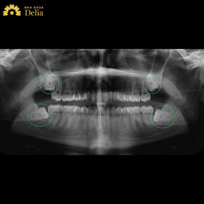 Trật tự cấu trúc răng bị ảnh hưởng