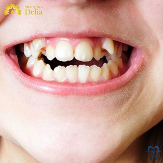 Hình ảnh răng lòi xỉ trông như thế nào? Lòi xỉ răng nên niềng răng?