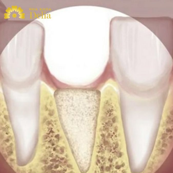 Trọn bộ hình ảnh tiêu xương ổ răng và những điều bạn nên biết về tiêu xương răng