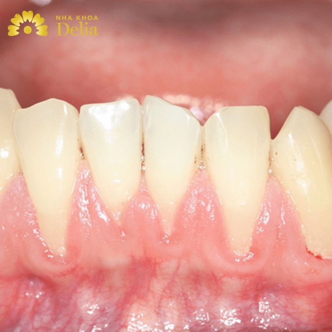 Ở vị trí mất răng, xương bị thu hẹp về chiều cao hoặc kích thước