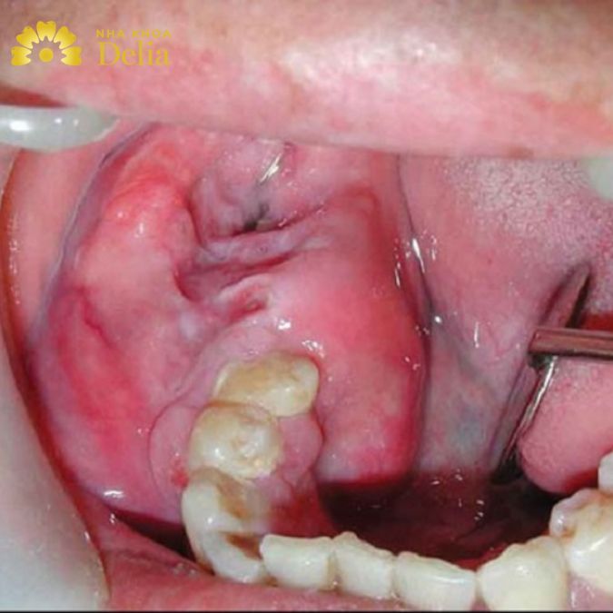 U răng ở giữa chân răng mọc và phần sau của hàm dưới