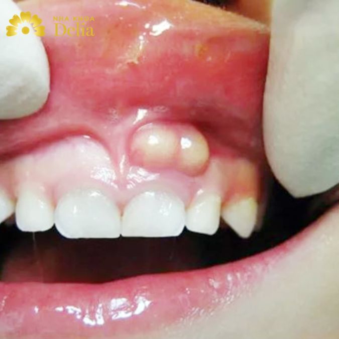 Hình ảnh u răng cửa - răng nanh