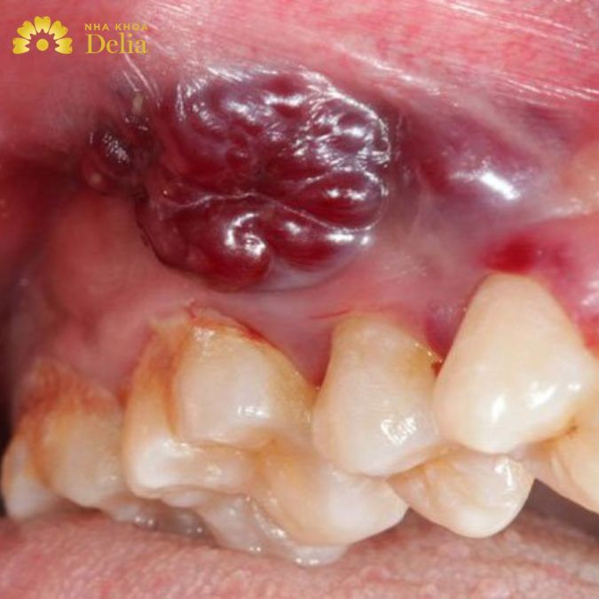 Nhận biết sớm bệnh bằng các hình ảnh ung thư nướu răng trong từng giai đoạn