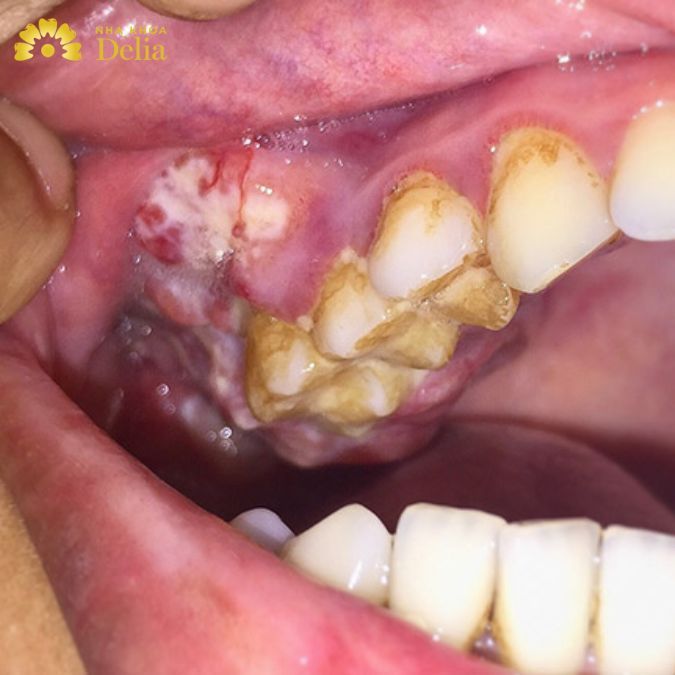 Khối u đã xâm lấn sâu vào mô xung quanh hoặc có kích thước lớn hơn 4cm