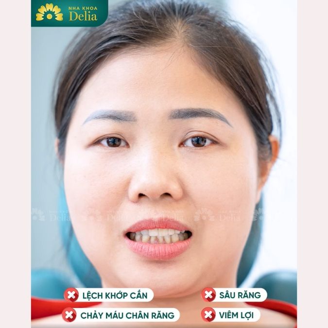 Khách hàng Hồng Thúy trải nghiệm làm răng sứ Emax tại nha khoa Delia