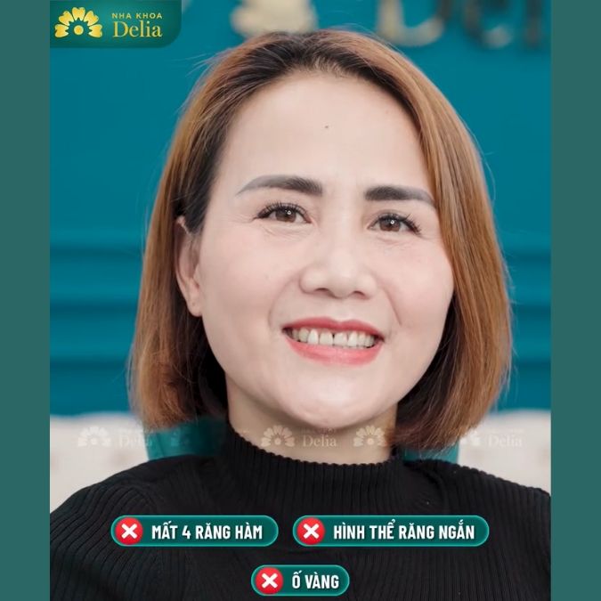 Khách hàng Thanh Mai trải nghiệm làm răng sứ Orodent Bleach tại nha khoa Delia