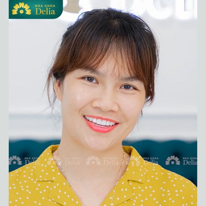 Khách hàng Thu Hương trải nghiệm bọc 20 răng sứ Emax tại nha khoa Delia
