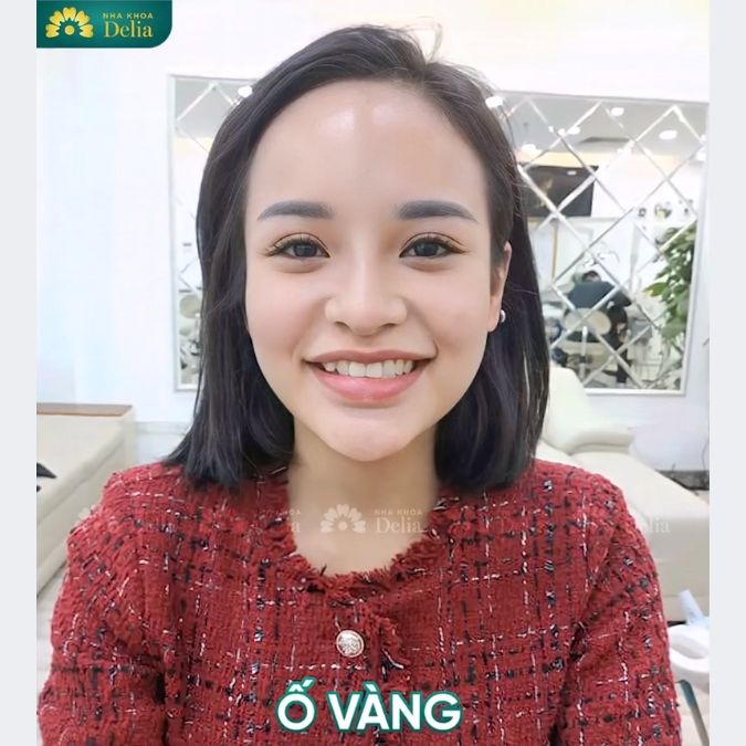 Khách hàng Tuyết Nhung trải nghiệm làm răng sứ Nacera Q3 tại nha khoa Delia