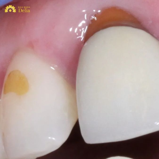 So sánh răng sứ kim loại và răng sứ titan