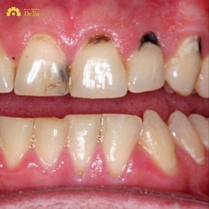 Hậu quả có thể gặp phải khi bọc răng sứ kim loại và răng sứ titan