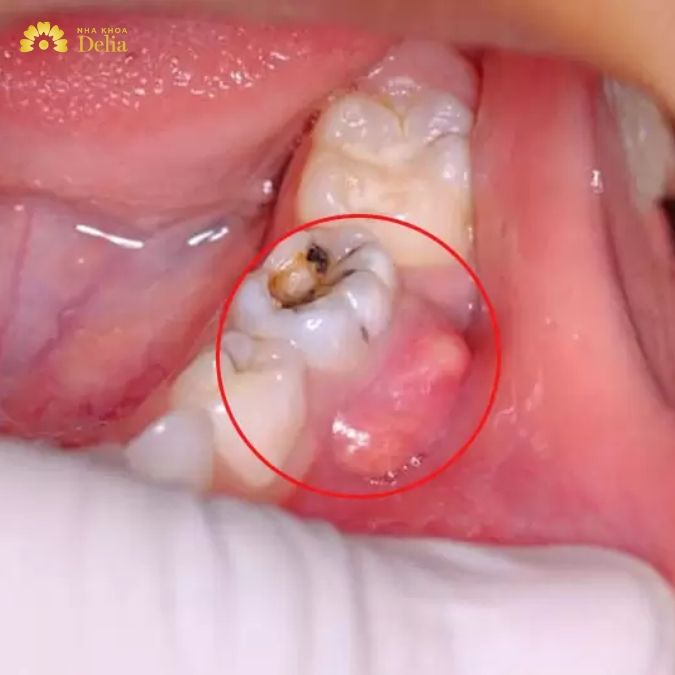 Hậu quả có thể gặp phải khi bọc răng sứ kim loại và răng sứ titan