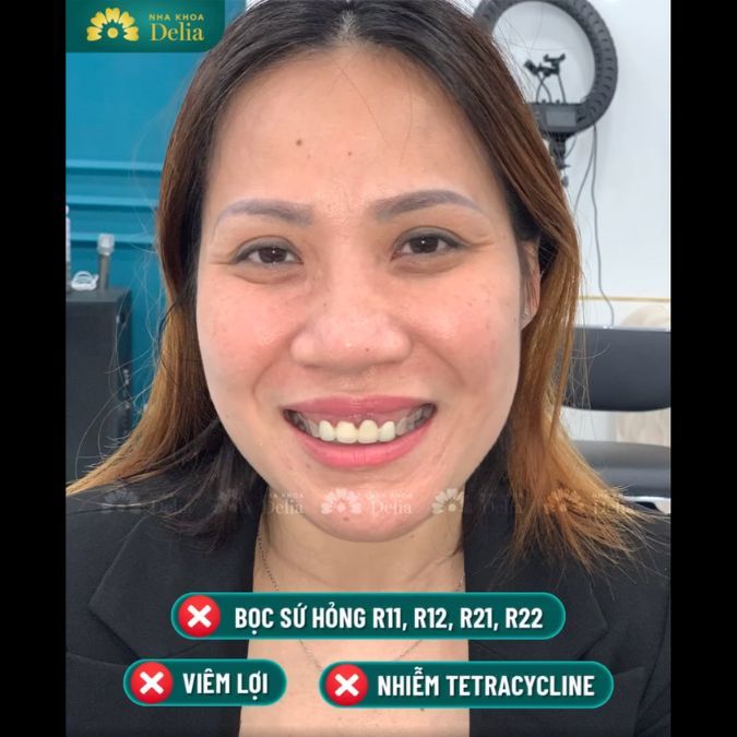 Chị Ninh Cúc đến với nha khoa Delia có tình trạng răng bọc sứ hỏng, viêm lợi và nhiễm Tetracycline