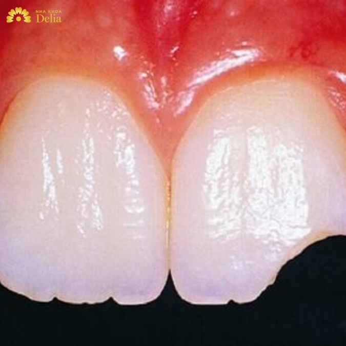 Việc tự hồi phục là điều không thể khi răng nứt vỡ