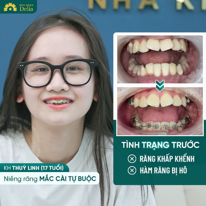 Niềng răng là phương pháp được đánh giá là có hiệu quả tối ưu nhất cho trẻ nhỏ có răng mọc khấp khểnh